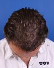 After Hair Transplant&nbsp;Temporal Hairline